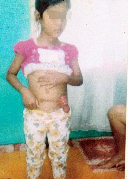 Derita Bocah Tanpa Anus  Natasya Melawan Sakit